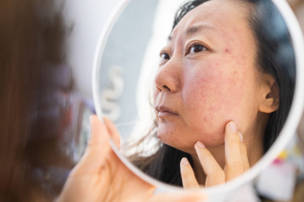 Woman examining dry, irritated skin on her cheek in a handheld mirror.