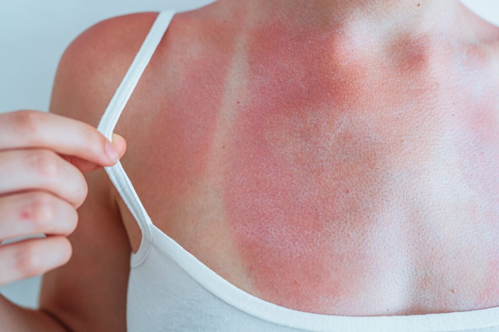Severe sunburn on woman’s chest and shoulders