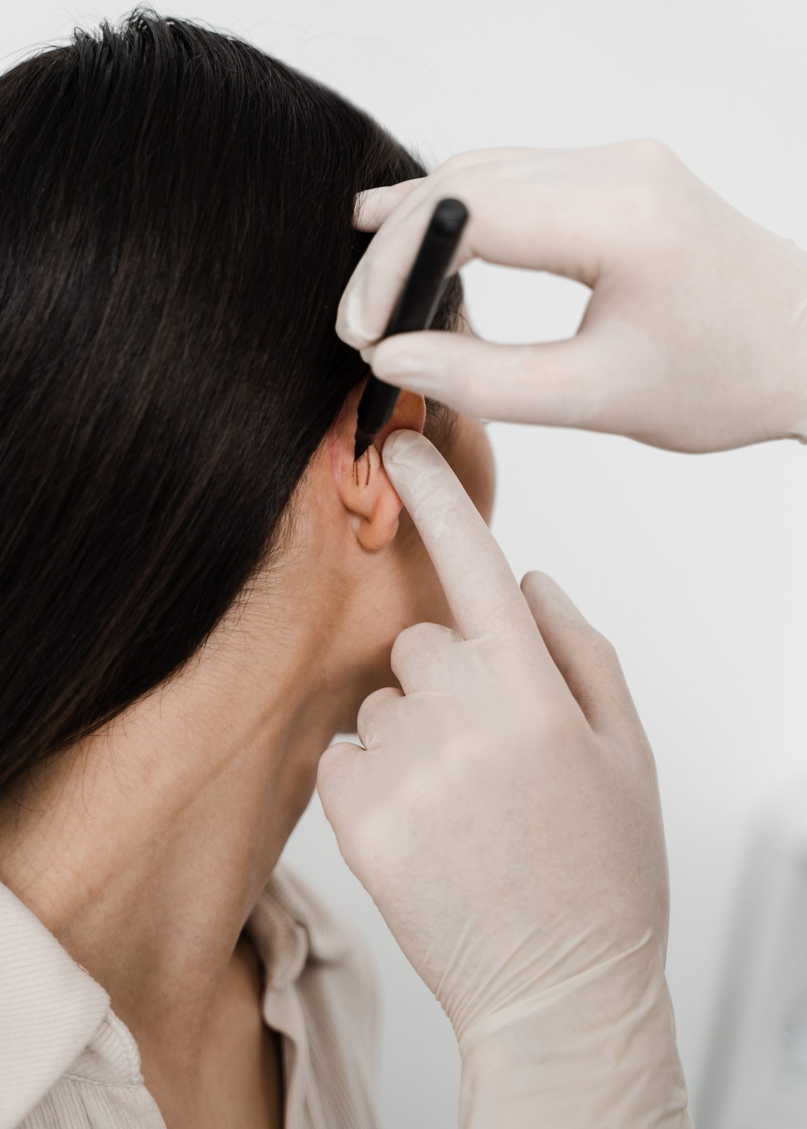 Surgeon draw marking on ear before otoplasty cosmetic surgery. Otoplasty markup before ear surgery. Otoplasty mark-up for surgical reshaping of pinna and ear