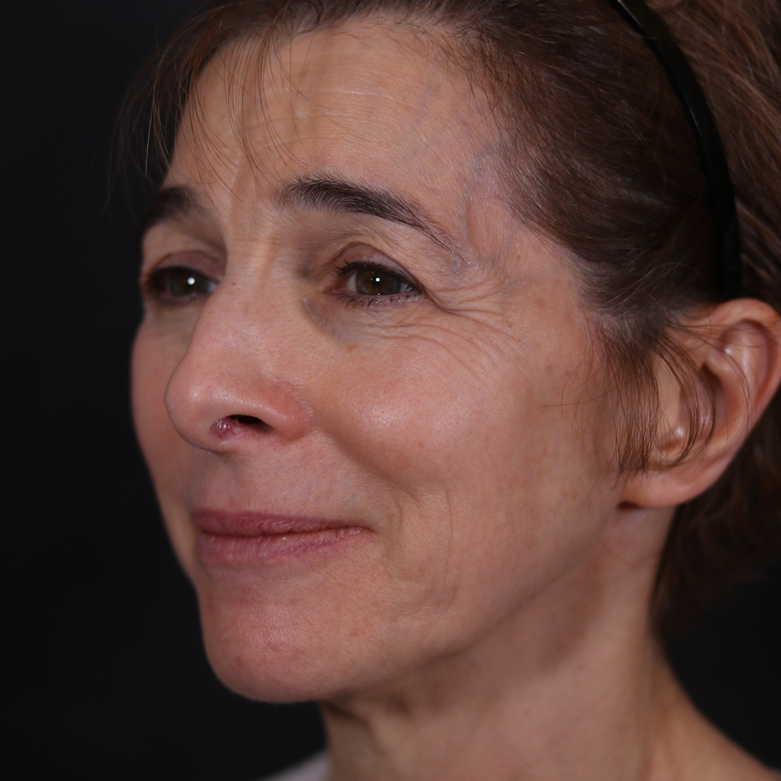 Endoscopic Facelift Before